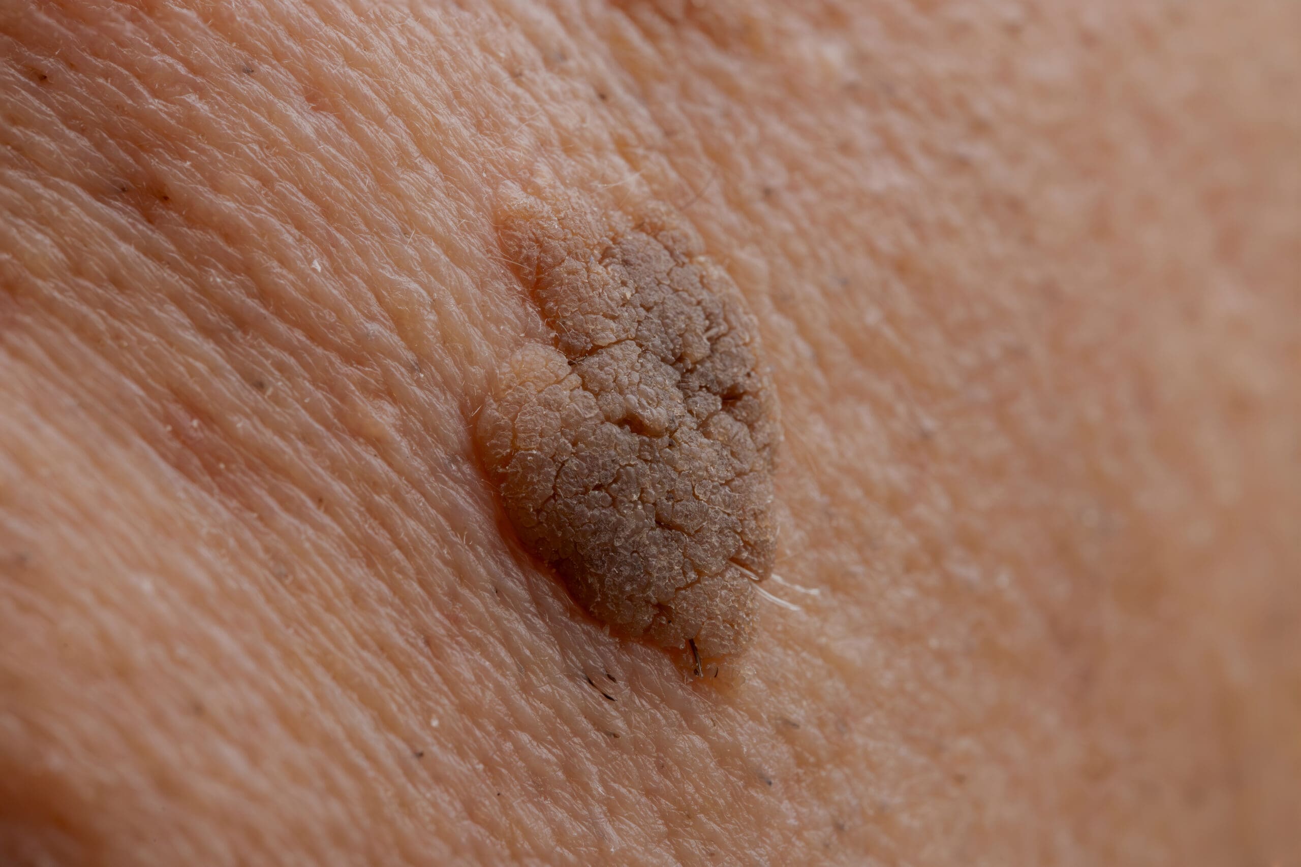 seborrhoeic keratosis removal seborrhoeic keratosis assessment treatment for seborrhoeic keratosis skin lesion consultation raised brown spots on skin