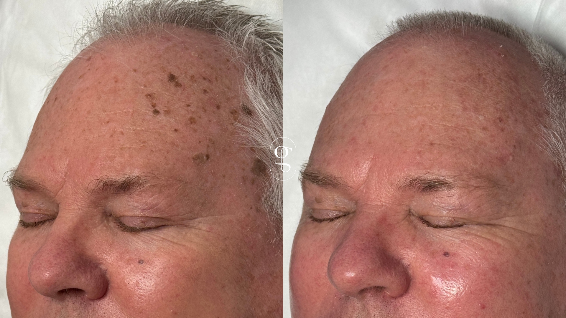 Skin - Lesions How To Treat Them